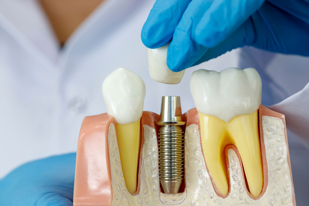 Dental Implants North York
